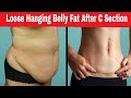 How To Reduce Belly Fat After Pregnancy | Get Flat Tummy After C - section