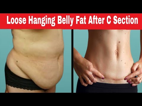 How To Reduce Belly Fat After Pregnancy | Get Flat Tummy After C – section
