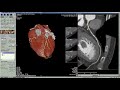 Vitrea Training /Tutorial on how to evaluate a coronary CT angiogram