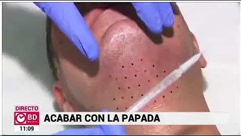 ¿Cuánto dura el Botox para la flacidez de la papada?