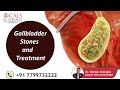 Gallbladder stones  drchetan mahajan  surgical gastroenterologist