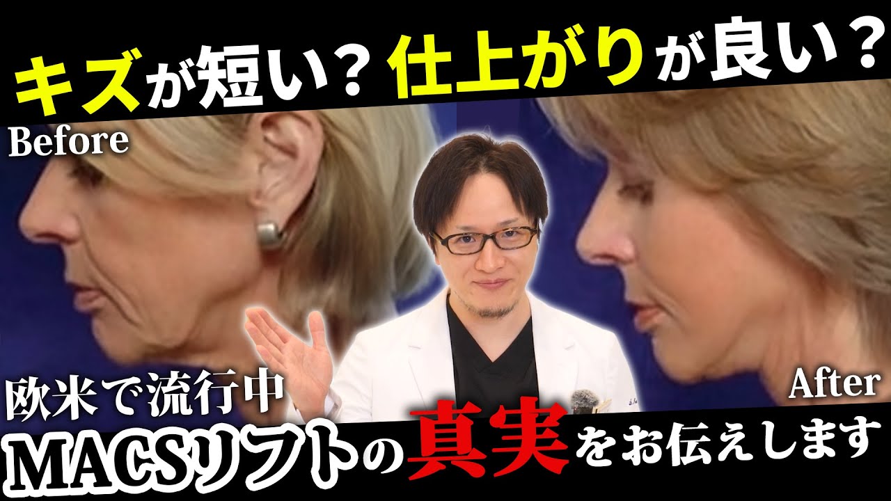 【たるみ治療】MACSリフトの真実をお伝えします。
