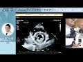 心エコー Zoomライブスキャンセミナー【2026.5.23開催】CareNet