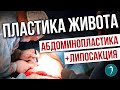 ПЛАСТИЧЕСКАЯ ОПЕРАЦИЯ ЖИВОТА. Абдоминопластика и липосакция живота. Пластическая хурургия Локтионов