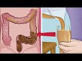 Get Rid Of Toxic Colon In Just 7 Days By Drinking This Mixture!