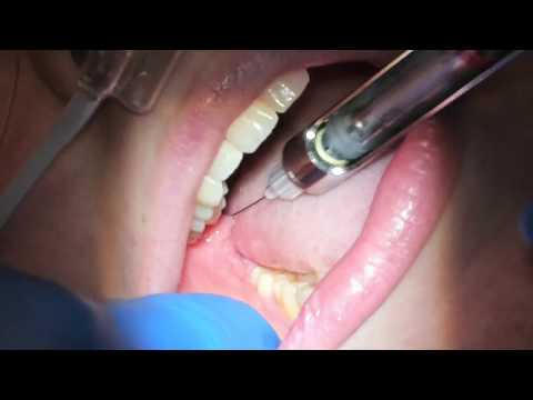 Local Anesthesia Technique for Wisdom teeth extraction WITHOUT PALATAL injection