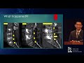 Complications of Spine Surgery from Osteoporosis   Christian Joaquin