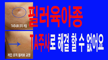 필러육아종에 TA주사,티에이주사,트리암,트리암시놀론 주사의 염증주사를 맞으면 안되는 이유를 동영상을 통해서 확인하시기 바랍니다.