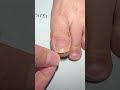 Toe Nail Fixer| Ingrown Toenail Cleaning & Care #ToenailFix #NailCare #FootCare #PedicureClean