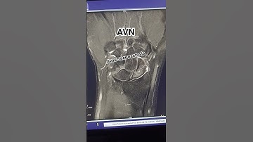 MRI Rt wrist AVN case #mri