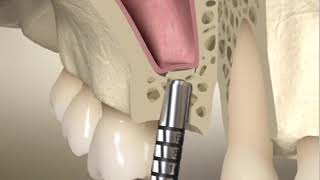 Transalveolar sinus lift