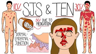 Understanding StevensJohnson Syndrome and Toxic Epidermal Necrolysis (SJS & TEN)