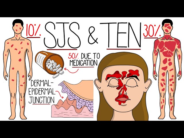 Understanding Stevens-Johnson Syndrome and Toxic Epidermal Necrolysis (SJS & TEN) class=