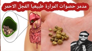 علاج جميع انواع حصى المرارة الكلسترولية او الحصى البليرونيه او حصى المرارة الفسفوريه طبيعا .