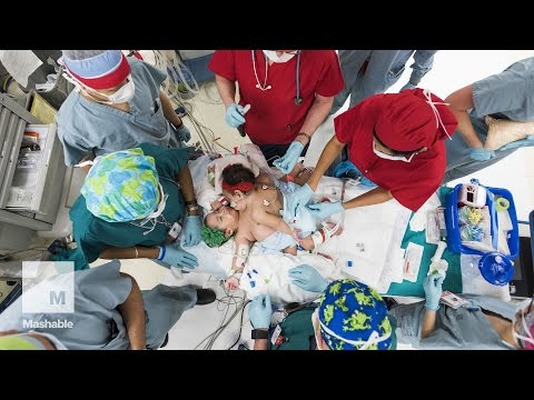 Conjoined twins survive 26-hour separation surgery | Mashable