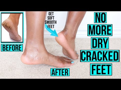 how-to-get-rid-of-dry-cracked-feet-fast-&-naturally-|-at-home-remedies-&-more