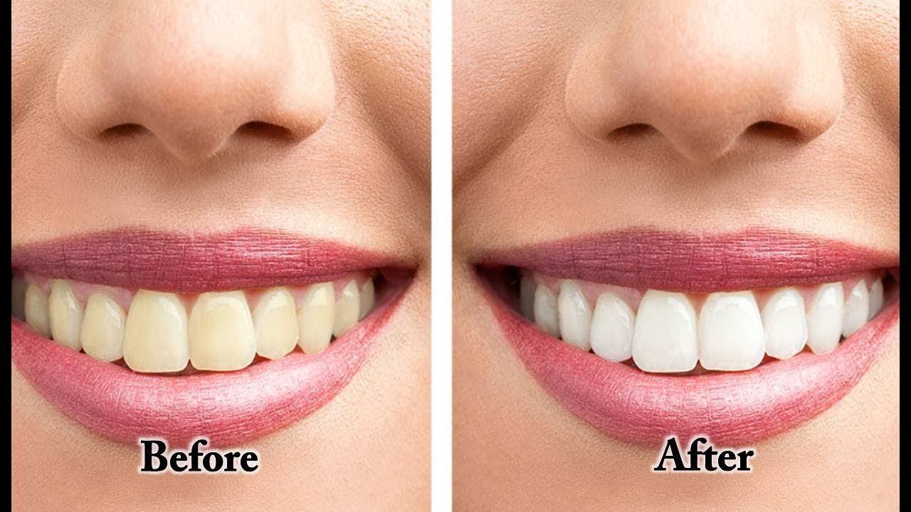 How to Whiten Teeth Yellow Teeth with Braces Teeth