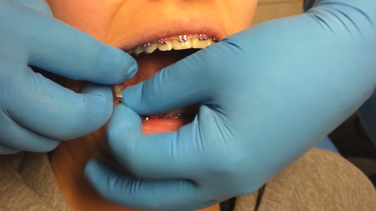 Cómo se coloca el Forsus corrector de clase 2, ortodoncia real en Regia