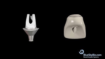 Custom Abutment from a Preformed Blank and Opaque White Metal