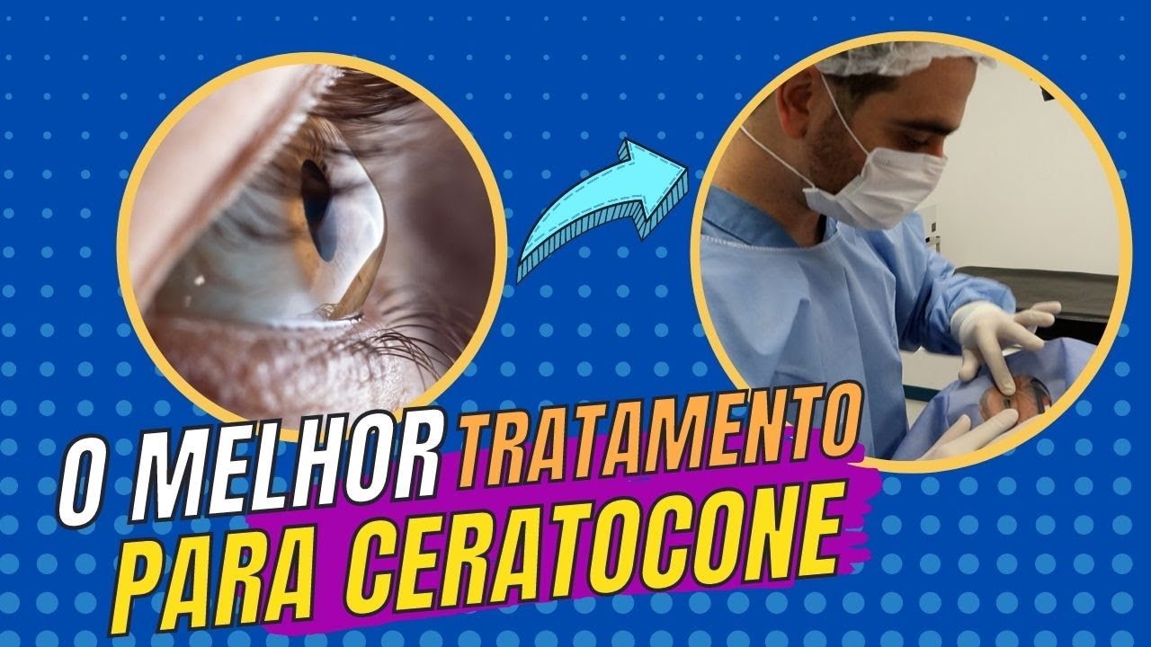 SOLUÇÃO PARA CERATOCONE COMO É FEITO O CROSSLINKING