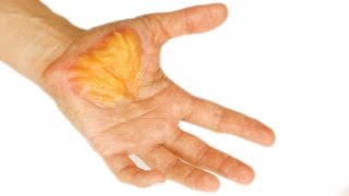 I have a Huge Blister!!! FX Series