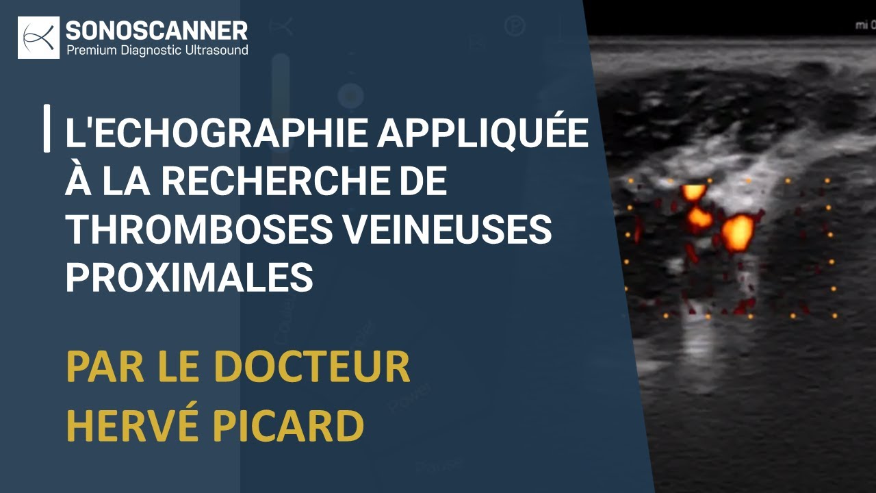 Webinar sonoscanner sur l'echographie appliquée à la recherche de thromboses veineuses proximales