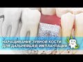 Наращивание зубной кости перед имплантацией / Синус лифтинг