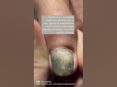 Какой кошмар .Что с ногтями ?#онизолизислечение #Ногти #маникюр# ...