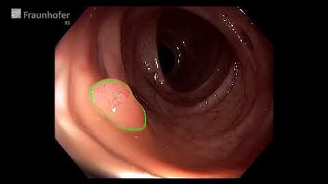 Real-time detection of polyps and lesions during the colonoscopy procedure