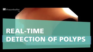 Real-time detection of polyps and lesions during the colonoscopy procedure