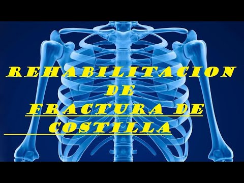 Video: Cómo tratar las costillas rotas: 8 pasos (con imágenes)