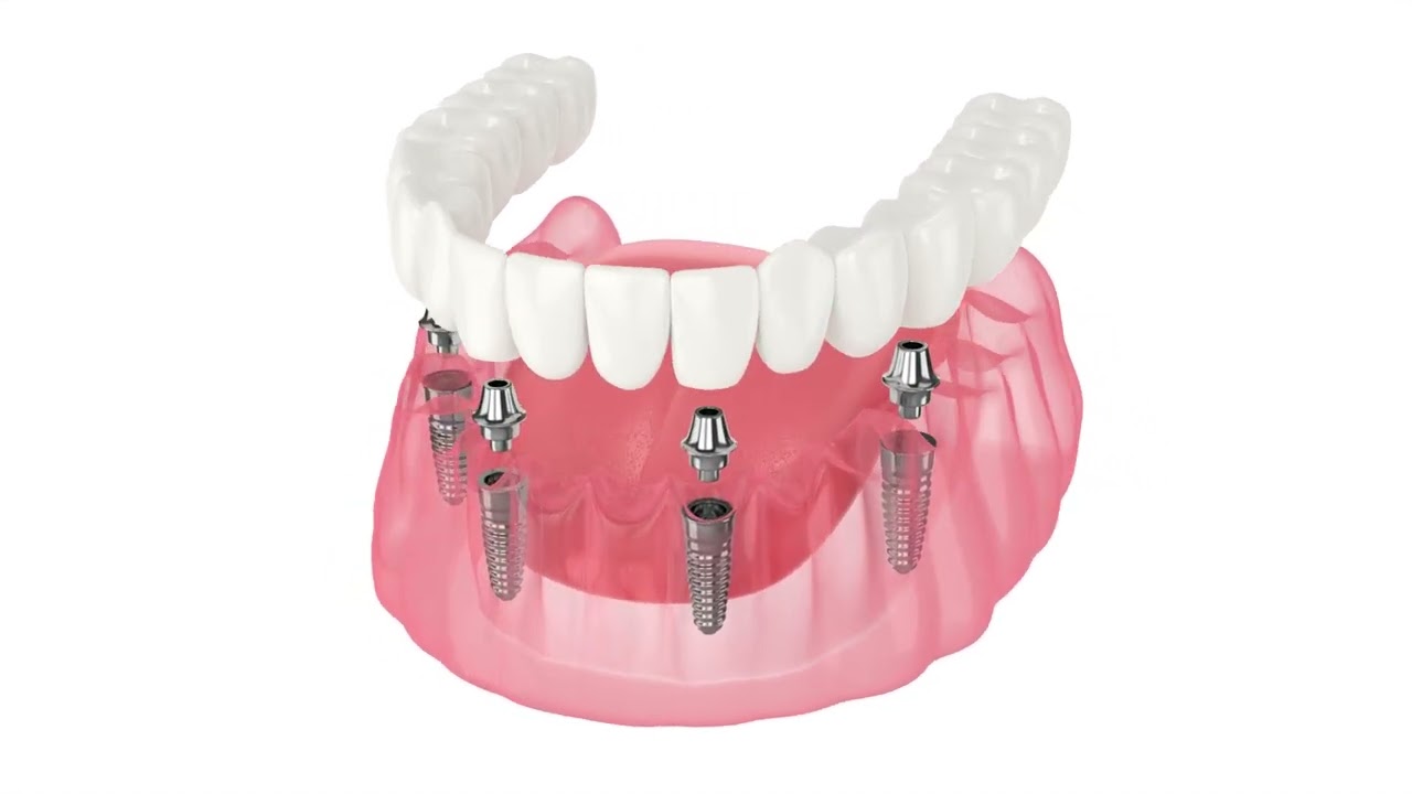 Prothèse fixe sur 4 implants dentaires, All-on-4 dans la mâchoire inférieure- EmpireDent en Hongrie