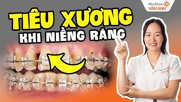 Tiêu Xương Khi Niềng Răng - 4 Dấu Hiệu Cho Thấy Cần Tái Khám Ngay