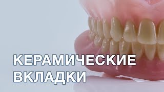 Керамические вкладки. Что это?