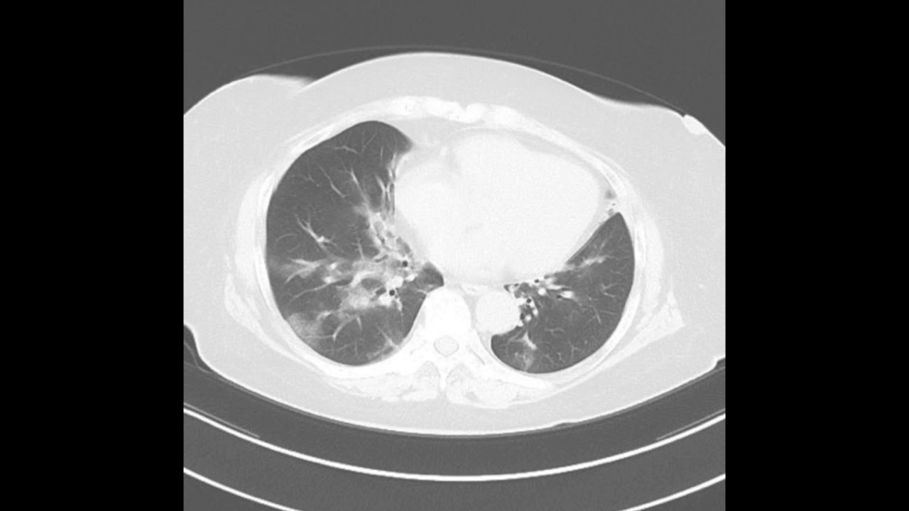 Ct画像あり ウイルス性肺炎まとめ 種類から症状 診断 治療まで