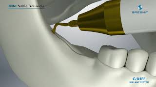 Piezo Gdiff Strauss Sus20 - Distribuit În România De Pcdental