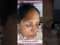 Peeling for hyperpigmentation treatments | Reduce pigmentation #pigmentation #hyperpigmentation