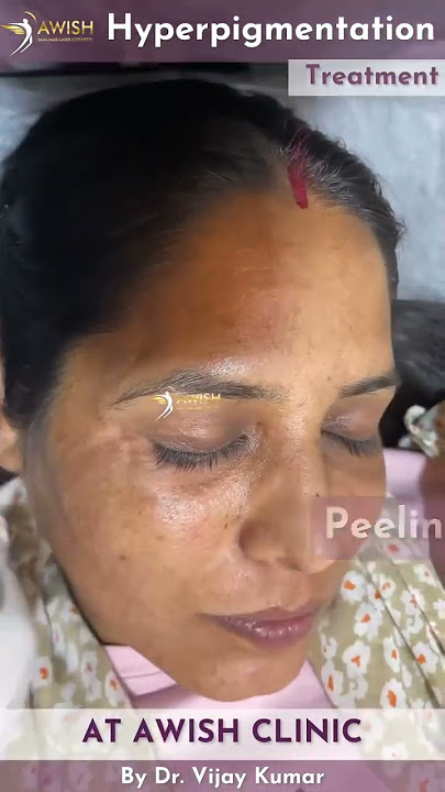 Peeling for hyperpigmentation treatments | Reduce pigmentation #pigmentation #hyperpigmentation