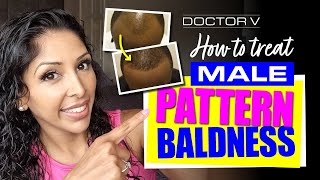 Doctor V - Male Pattern Baldness | Skin Of Colour | Brown Or Black Skin