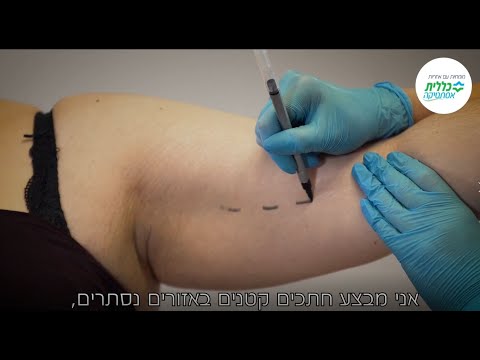 ניתוח שאיבת שומן בכללית אסתטיקה