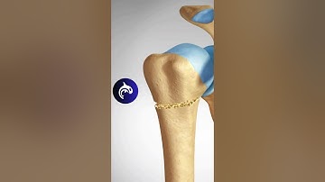 Shoulder Fracture: See Different Proximal Humeral Fractures in 3D #fracture #shoulder