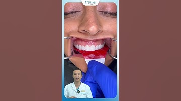 Cách Đo Khớp Cắn Chuẩn Răng Sứ | Bác Sĩ Yên