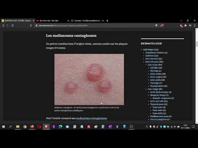 Boutons Sur Le Pubis Bouton Sur Le Bas Ventre Youtube