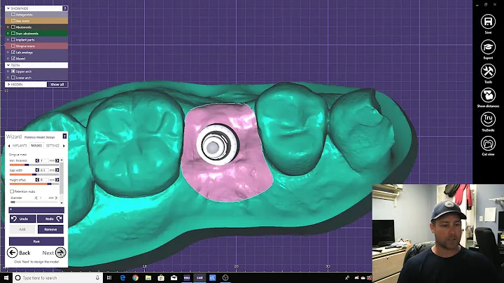 How to: Create Implant Models from Intra Oral Scans