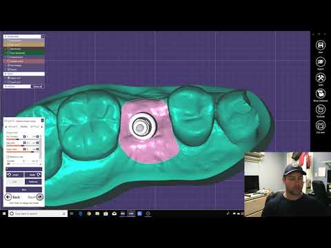 How to: Create Implant Models from Intra Oral Scans