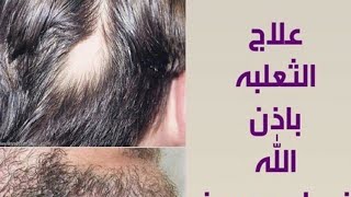 كيفية علاج مرض ثعلبة الشعر بالاعشاب الطبيعية تخلص منها نهائيا وتمتع بمظهر جميل وجذاب