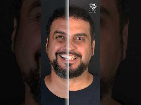 شاهدوا الابتسامة الجديدة لمريضنا بعد اجراء ابتسامة هوليود