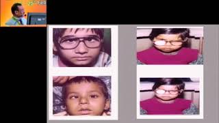 AIOC2018 - GP038 - Topic -Role of Patching in Treatment of Amblyopia