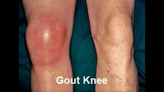 GOUT | Crystals ooze from toe  #gout #goutto