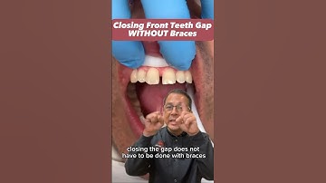 Fixing Front Teeth Gap in ONE Appointment EXPLAINED | In Office to Hands On Dental Training #shorts